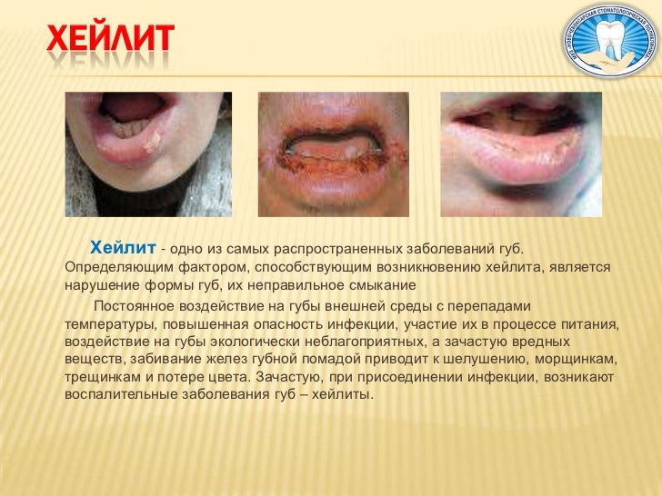 Слизистая рта нормальный цвет Слизистая рта нормальный цвет