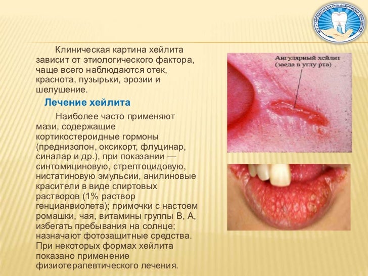 Слизистая рта нормальный цвет Слизистая рта нормальный цвет