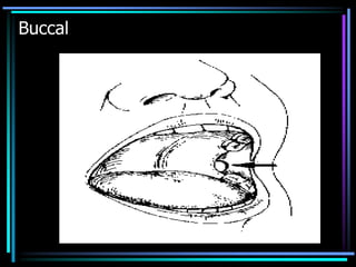 Buccal
 
