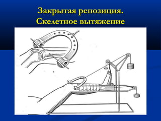 Закрытая репозиция.Закрытая репозиция.
Скелетное вытяжениеСкелетное вытяжение
 