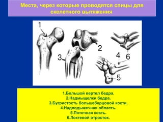 г
Места, через которые проводятся спицы для
скелетного вытяжения
1.Большой вертел бедра.
2.Надмыщелки бедра.
3.Бугристость большеберцовой кости.
4.Надлодыжечная область.
5.Пяточная кость.
6.Локтевой отросток.
 