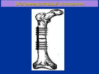 Экстрамедуллярный остеосинтезЭкстрамедуллярный остеосинтез
 