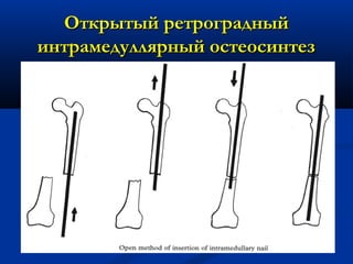 Открытый ретроградныйОткрытый ретроградный
интрамедуллярный остеосинтезинтрамедуллярный остеосинтез
 