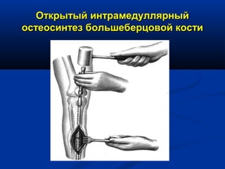 Открытый интрамедуллярныйОткрытый интрамедуллярный
остеосинтез большеберцовой костиостеосинтез большеберцовой кости
 