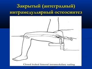 Закрытый (антеградный)Закрытый (антеградный)
интрамедуллярный остеосинтезинтрамедуллярный остеосинтез
 