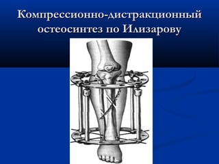 Компрессионно-дистракционныйКомпрессионно-дистракционный
остеосинтез по Илизаровуостеосинтез по Илизарову
 