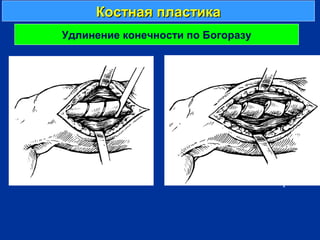 Костная пластикаКостная пластика
г
Удлинение конечности по Богоразу
 