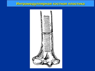 Интрамедуллярная костная пластикаИнтрамедуллярная костная пластика
 