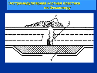 Экстрамедуллярная костная пластикаЭкстрамедуллярная костная пластика
по Фемистерупо Фемистеру
 