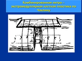 Комбинированная интра –Комбинированная интра –
экстрамедуллярная костная пластика поэкстрамедуллярная костная пластика по
ЧаклинуЧаклину
 