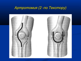 Артротомия (2 -по Текстору)Артротомия (2 -по Текстору)
 
