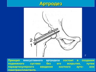 АртродезАртродез
г
Принцип внесуставного артродеза состоит в создании
подвижного сустава без его вскрытия, путем
параартикулярного введения костного ауто- или
гомотрансплантанта.
 