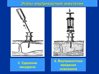 Этапы внутрикостной анестезииЭтапы внутрикостной анестезии
3. Удаление
мандрена
4. Внутрикостное
введение
новокаина
 