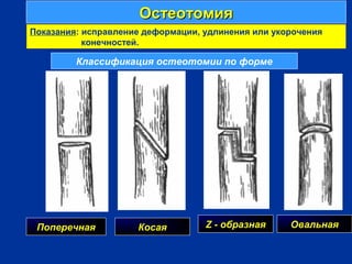 ОстеотомияОстеотомия
г
Показания: исправление деформации, удлинения или укорочения
конечностей.
Классификация остеотомии по форме
Поперечная Косая Z - образная Овальная
 