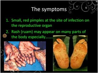 The symptomsSmall, red pimples at the site of infection on the reproductive organRash (ruam) may appear on many parts of the body especially………..
