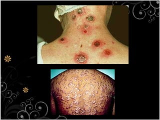 1.4 the harmful effects of microorganism