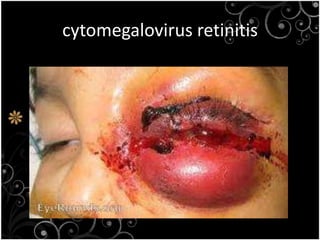 WAYS OF INFECTIONSHARING SYRINGES  SEXUAL CONTACT WITH THE PATIENT