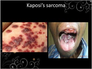 SYMPTOMSEnlarged lymph glandsTirednessFeverLoss of appetite and weightDiarrhea Yeast infections of mouth and vaginaPneumonia Yeast infections of esophagus, cytomegalovirus retinitisKaposi’s sarcomaTuberculosis 