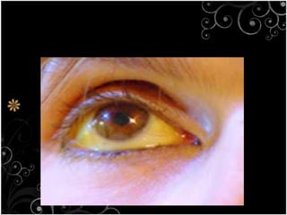 HEPATITISIt is a disease of liverCaused by alcohol, drugs and viruses