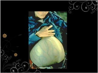Symptoms Fatigue Poor appetiteNausea Pain in the abdomen ( over the liver)Urine become darkJaundice ( yellow skin colour)Liver failureDead Cirrhosis 