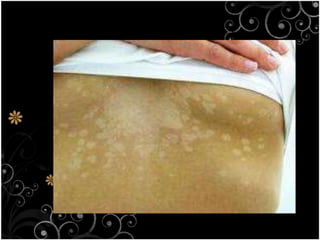 Disease caused by fungi 2 common fungal disease tinearingworm
