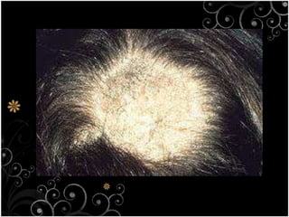 TineaWhite spot on facial skin, body, hands and feetInfected area looks brighter than the uninfected area