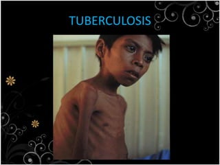 TUBERCULOSIS