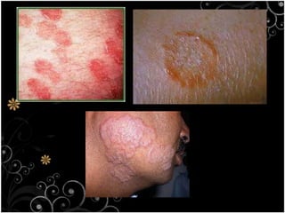Ringworm Caused by tiny fungiItching or may not be a symptoms