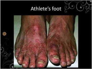 1.4 the harmful effects of microorganism