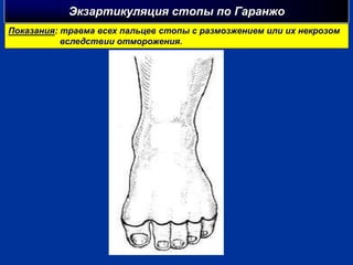 Экзартикуляция стопы по Гаранжо
Показания: травма всех пальцев стопы с размозжением или их некрозом
вследствии отморожения.
 