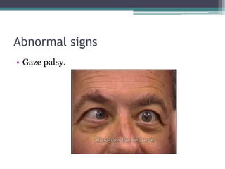 Abnormal signs
• Gaze palsy.
 