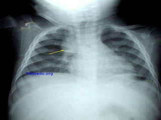 ARTERIA TORACICA INTERNA DERECHA
ARTERIA TORACICA INTERNA
IZQUIERDA
NIVEL VERTEBRAL IV-V
TIMO
SACO PERICARDICO
104
 
