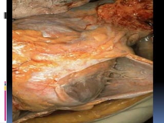 PERICARDITIS
 En los casos de pericarditis, estas membranas inflamadas
se tornan ásperas, rozan una contra otra produciendo
ruidos o frotes que pueden ser auscultados y ayudan al
diagnóstico clínico y exudan una cantidad mayor de
líquido haciendo real la separación entre ambas
membranas.
 El exceso de líquido pericárdico constituye entonces un
derrame pericárdico el cual, dependiendo de la velocidad
de producción, de la cantidad y de la capacidad de
distensión del pericardio, puede dificultar o impedir el
llenado con sangre de las cavidades cardíacas
ocasionando un taponamiento pericárdico.
 