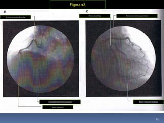 Arteria coronaria derecha
Rama interventricular posterior
Rama marginal
Rama circunfleja Rama interventricular anterior
Rama marginal izquierda
Figura 18
65
 