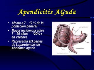 Apendicitis AGuda Afecta a 7 – 12 % de la población general Mayor incidencia entre 7 – 30 años  *20% + en varones Representa 2/3 partes de Laparotomías de  Abdomen agudo 