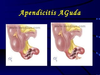 Apendicitis AGuda 