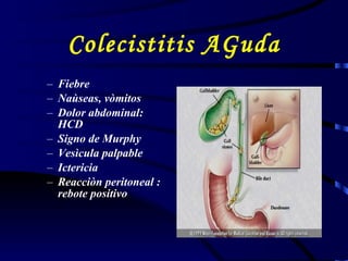 Colecistitis AGuda Fiebre  Naùseas, vòmitos Dolor abdominal: HCD Signo de Murphy Vesìcula palpable Ictericia Reacciòn peritoneal : rebote positivo 