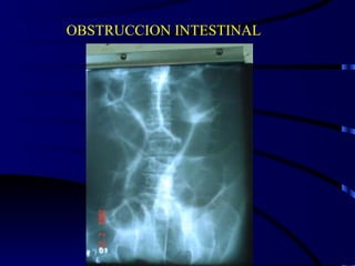 OBSTRUCCION INTESTINAL 