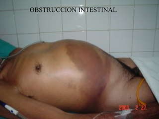 OBSTRUCCION INTESTINAL 