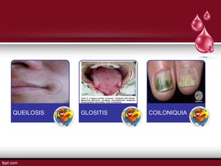 QUEILOSIS   GLOSITIS   COILONIQUIA
 