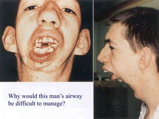 Why would this man’s airway
be difficult to manage?
 