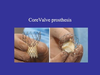 1- Aortic Valve Diseases Cardiovascular Module | PDF