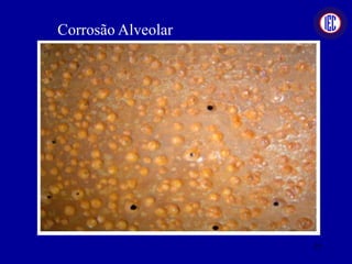 Corrosão Alveolar
77
 
