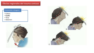 Biomecánica del trauma | PPTX