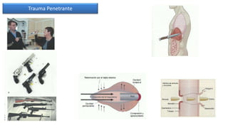 Biomecánica del trauma | PPTX