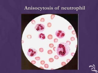 Anisocytosis of neutrophil
 
