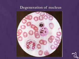 Degeneration of nucleus
 