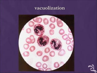 vacuolization
 