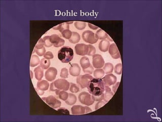 Dohle body
 
