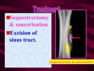 Bone and Joint Infection | PPT